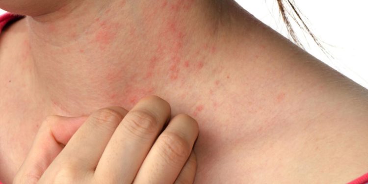 Uyuz vakaları artıyor: ‘Tüm ailenin birlikte tedavi olması önemli’