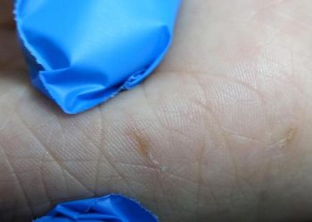 Uzmanı açıkladı: Uyuz nasıl geçer?