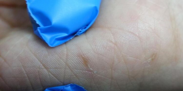 Uzmanı açıkladı: Uyuz nasıl geçer?